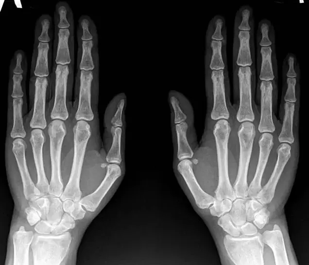 X-ray shows wrist arthritis before using Hondroine
