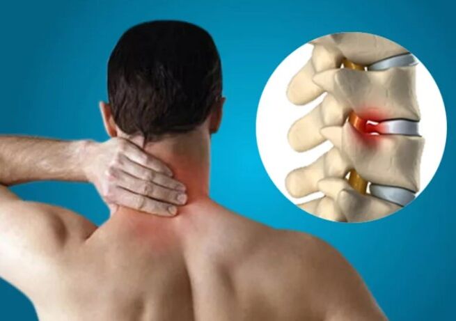 Neck bone and chondropathy