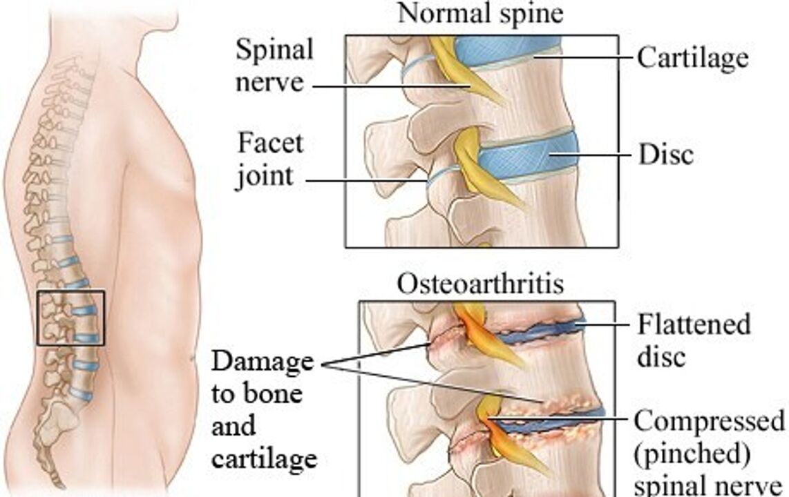 Differences between healthy disks and intervertebral discs with osteocartilage degeneration