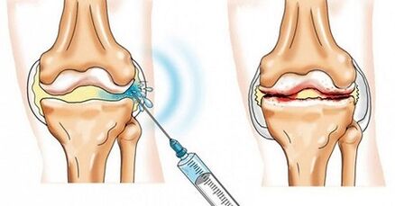 How to treat knee joints